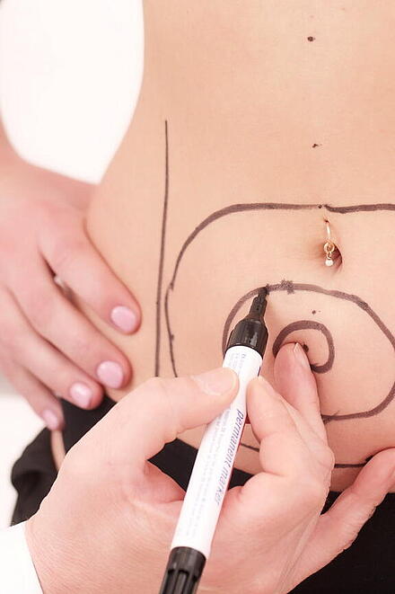 Einzeichnung von Kreisen auf Frauenbauch für CoolSculpting